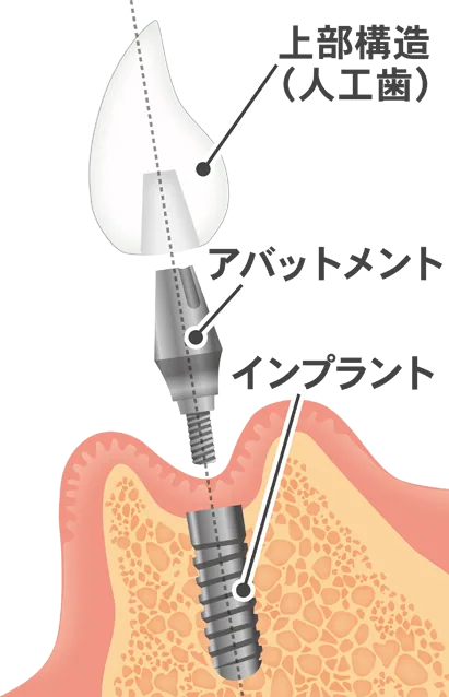 インプラントの「構造」