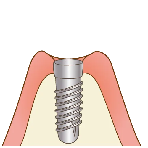 インプラント手術(1次手術)