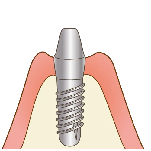 インプラント手術（2次手術）