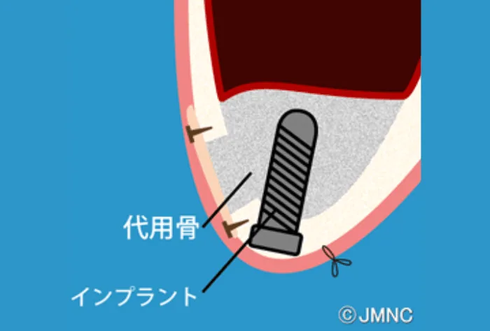 他院で断られてしまった方へ当院で行う 「骨造成の種類」