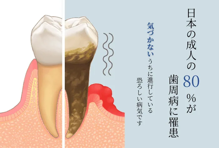 歯周病について
