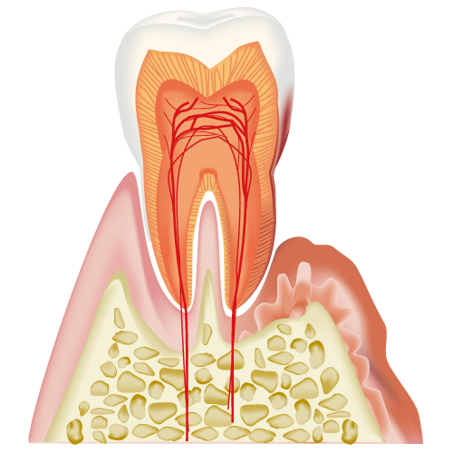歯の断面（歯周病）