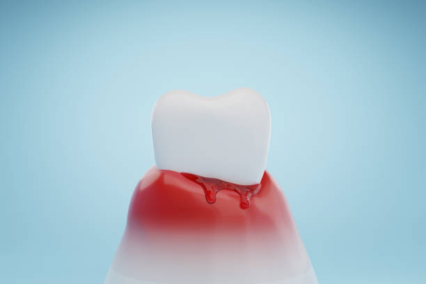 歯周炎による出血のイラスト