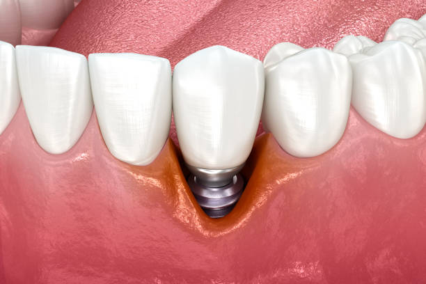 歯のインプラントが抜歯された箇所に入っている様子