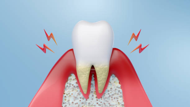 歯の健康の健康を表した歯周病の3Dレンダリング。