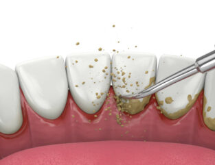 スケーラーによる歯の歯垢と歯石の除去