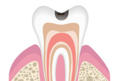 虫歯の進行段階C１
