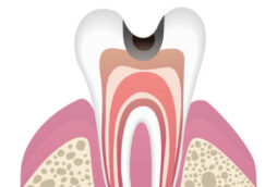 虫歯の進行段階C2
