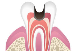 虫歯の進行段階C3
