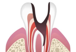 虫歯の進行段階C４